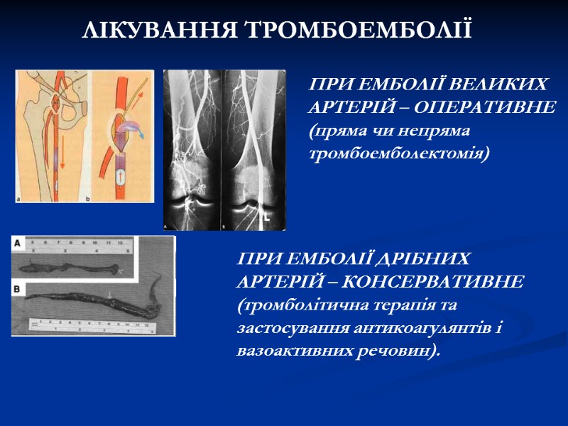 ЛІКУВАННЯ ТРОМБОЕМБОЛІЇ ПРИ ЕМБОЛІЇ ВЕЛИКИХ АРТЕРІЙ – ОПЕРАТИВНЕ (пряма чи непряма тромбоемболектомія) ПРИ ЛІКУВАННЯ ТРОМБОЕМБОЛІЇ ПРИ ЕМБОЛІЇ ВЕЛИКИХ АРТЕРІЙ – ОПЕРАТИВНЕ (пряма чи непряма тромбоемболектомія) ПРИ